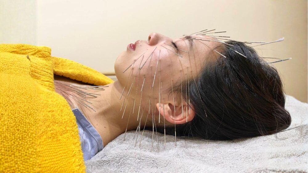 美容鍼
